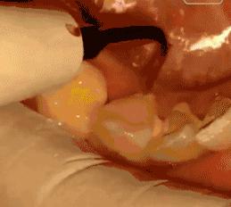 洗牙会伤害牙齿科普,洗牙会破坏牙保护膜么