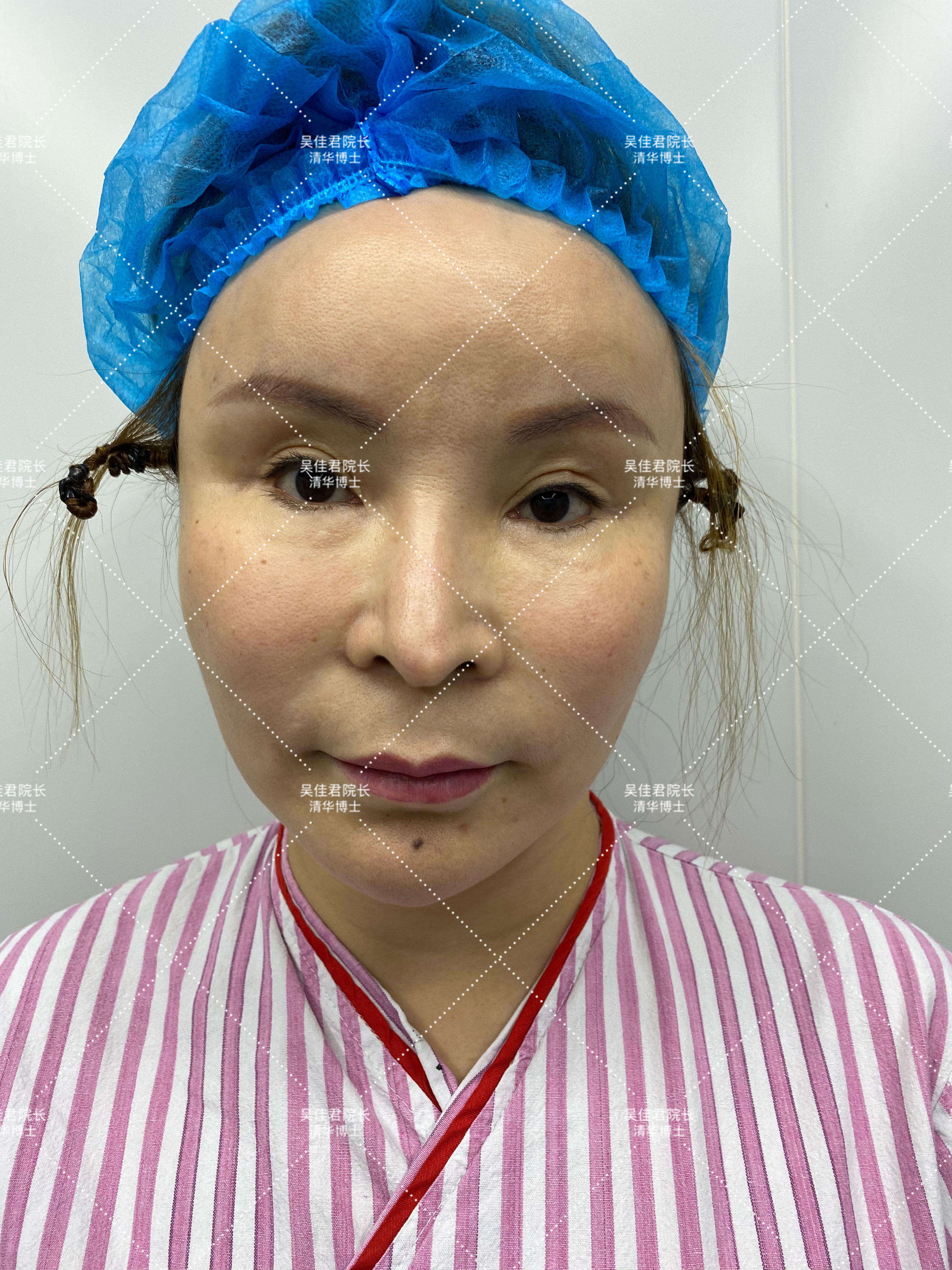 做小拉皮术后怎么保养,做拉皮手术的亲身经历注意事项