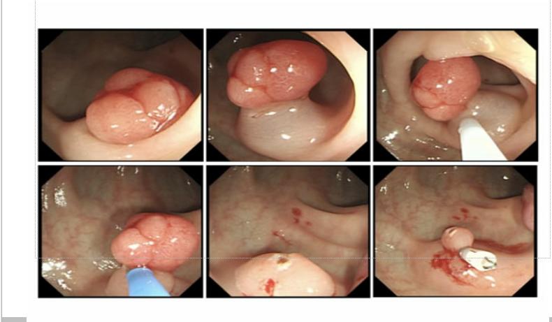 多发息肉和单发息肉哪个容易癌变,分叶息肉和带蒂息肉哪个容易癌变