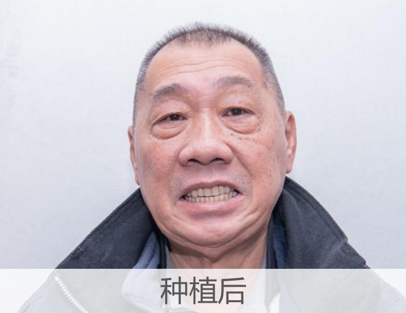 烤瓷牙延长寿命的方法,烤瓷牙的修复方法