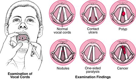 配音员嗓子,配音员嗓子哑了