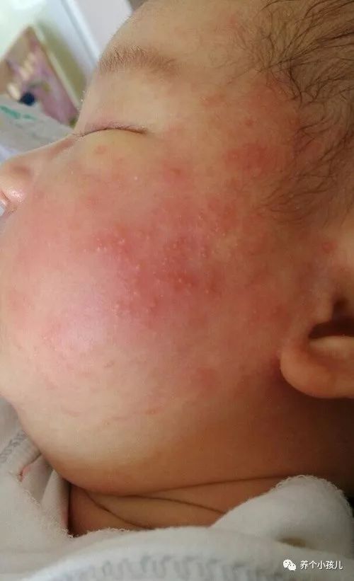 宝宝出现湿疹的原因和护理措施,高烧湿疹的症状及治疗方法