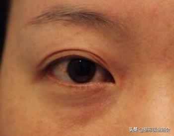 祛眼袋导致外翻怎么办,祛眼袋手术后有细纹会慢慢恢复吗