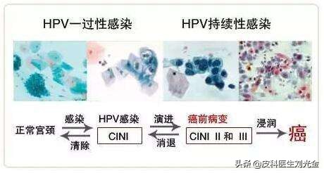 感染了HPV，应该知道哪些问题？