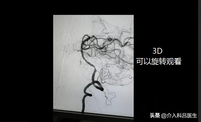 检查心血管必须做造影吗,心血管造影和冠脉造影有区别吗