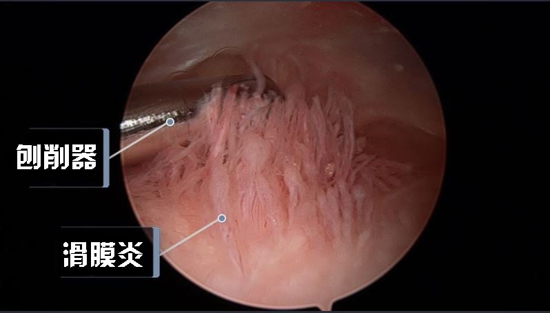 类风湿吃什么药能缓解疼痛呢,吃什么药可以缓解风湿类风湿疼痛