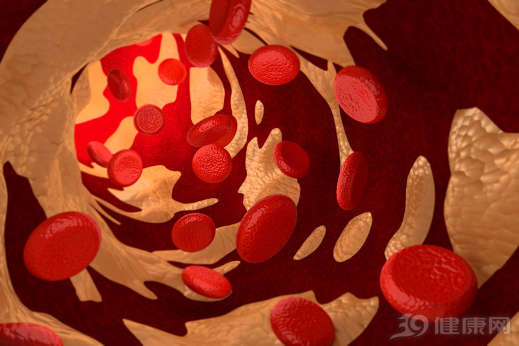 左右颈动脉堵塞会中风吗,怎么能避免颈动脉血管堵塞