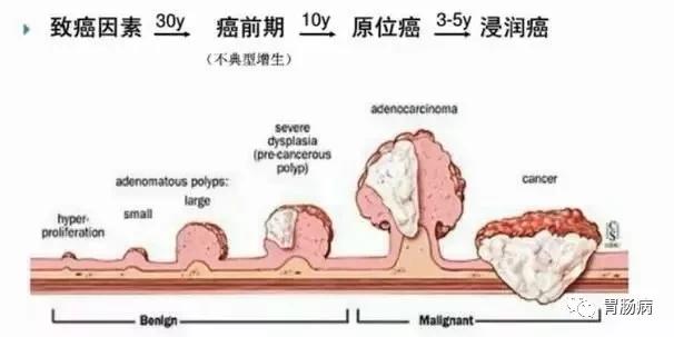 肠息肉切除后3年得肠癌,女性肠息肉切除多久可以恢复
