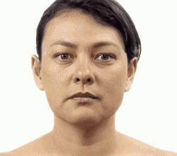 大拉皮术后50天真实感受,拉皮手术5年之后的变化