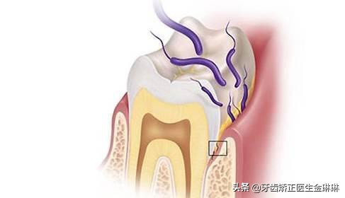 大牙缝隙变黑有个洞怎么办,牙齿黑缝