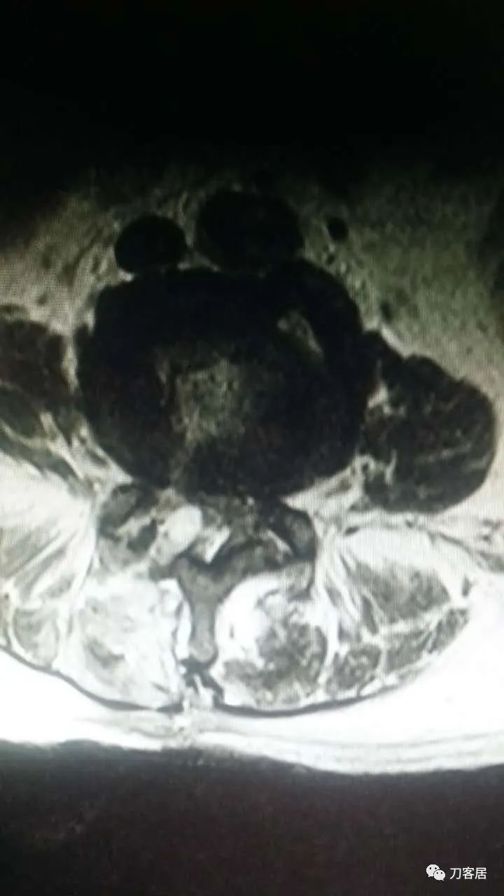 腰椎手术切掉棘突,腰突微创后出血肿