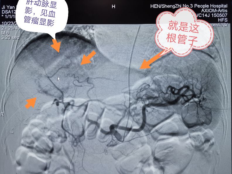 肝血管瘤10公分了介入治疗可以吗,介入治疗肝血管瘤是最好的方案吗