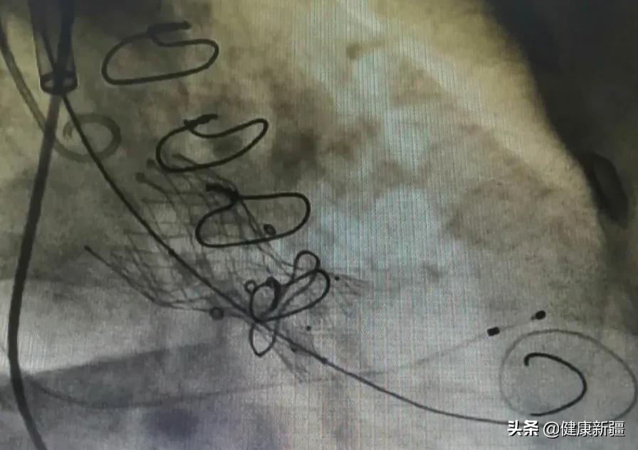 瓣膜修复首次开胸二次可微创吗,瓣膜二次手术