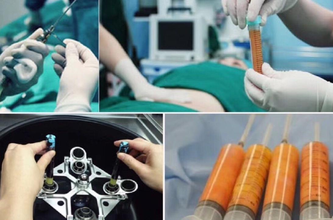 太阳穴凹陷自体脂肪填充怎么样,太阳穴凹陷显凶吗