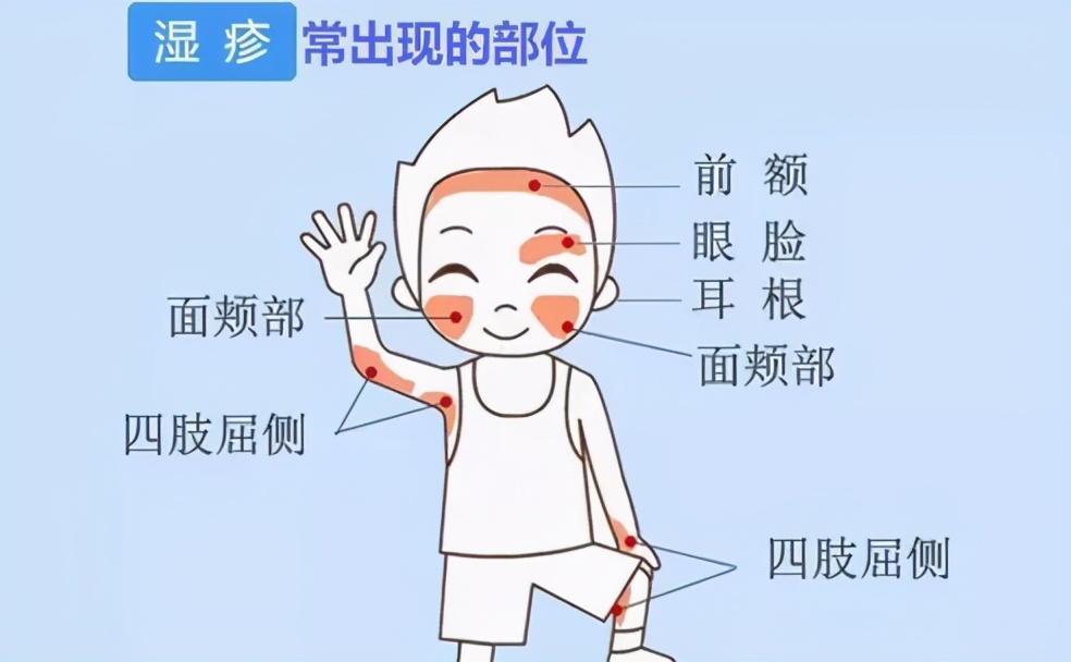 宝宝湿疹严重反反复复怎么办,宝宝湿疹反反复复一直不好怎么办