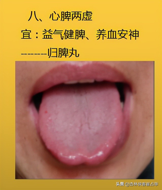 生理性齿痕舌与病理性齿痕舌,齿痕舌形成的原因是脾虚还是瘀血