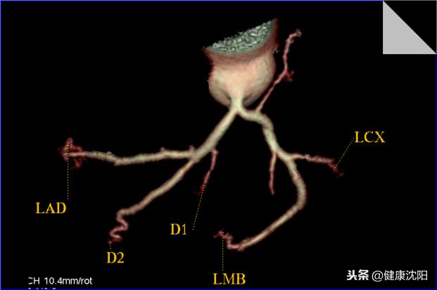 cta和血管造影怎么选择,血管oct检查与血管造影检查的区别