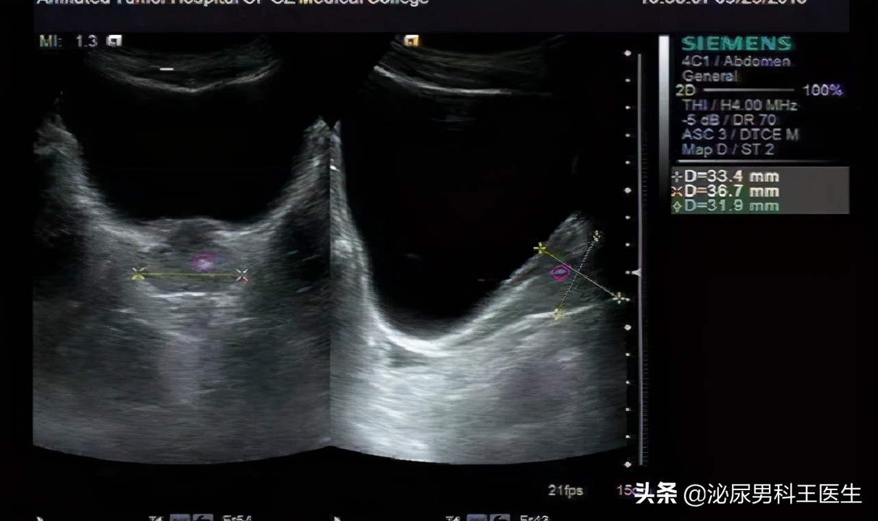 前列腺钙化是结石的表现吗,前列腺钙化有哪些症状表现