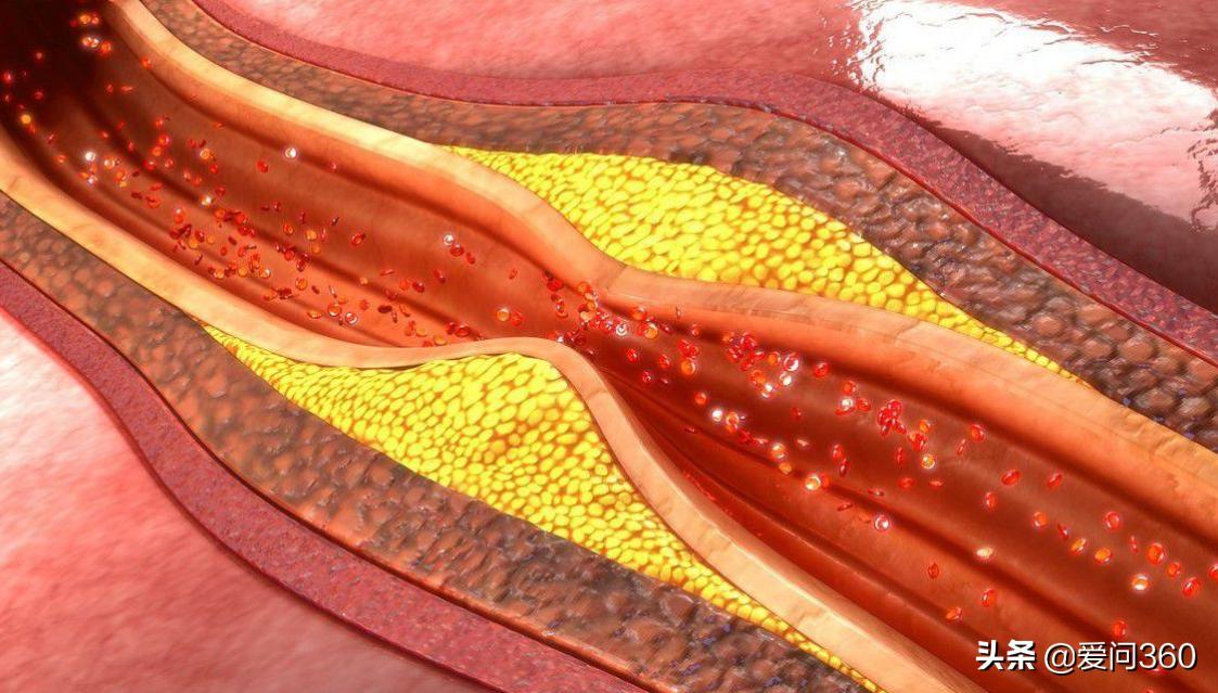 血管没有弹性什么原因该怎么治,血管失去弹性与血虚有关吗