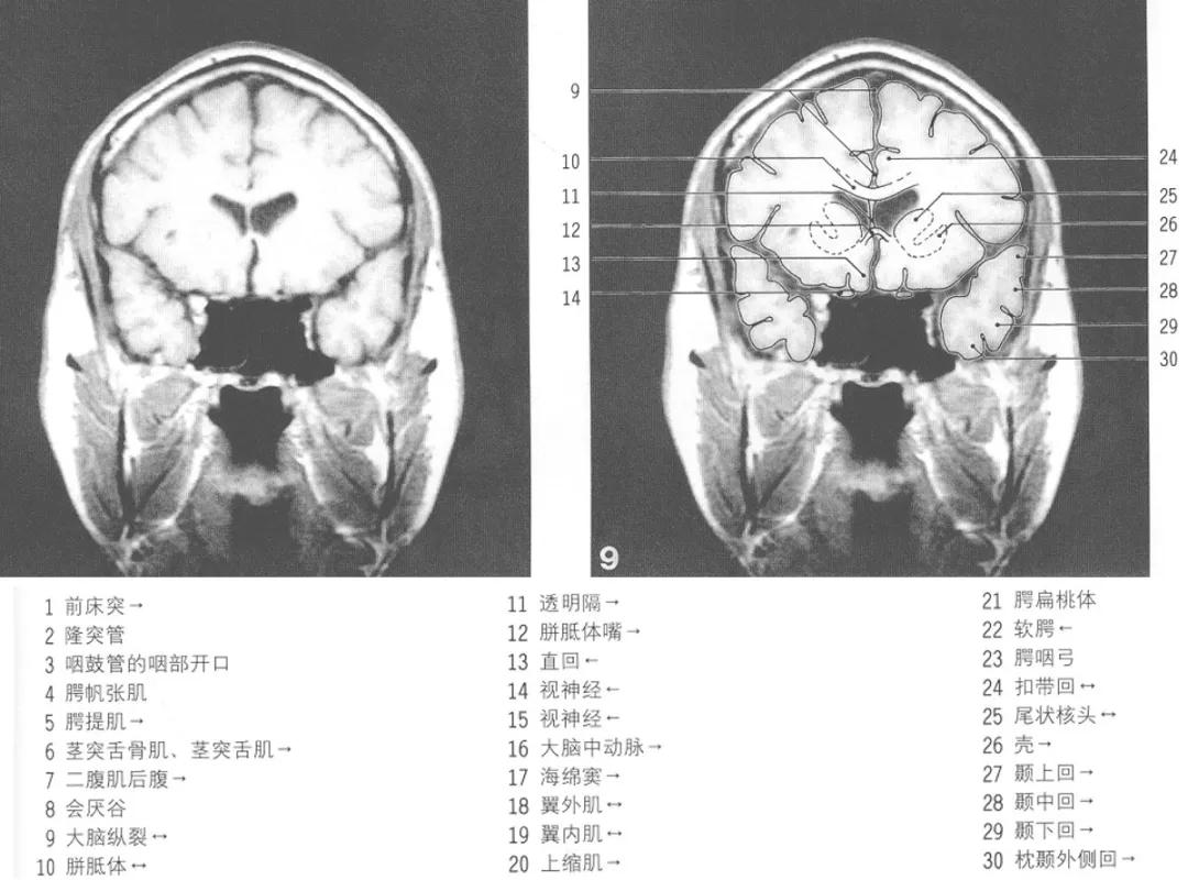 颅脑冠状状切面解剖图,颅脑mr解剖结构图