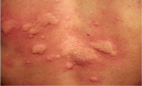 麻疹的诊断标准是什么,麻疹诊断