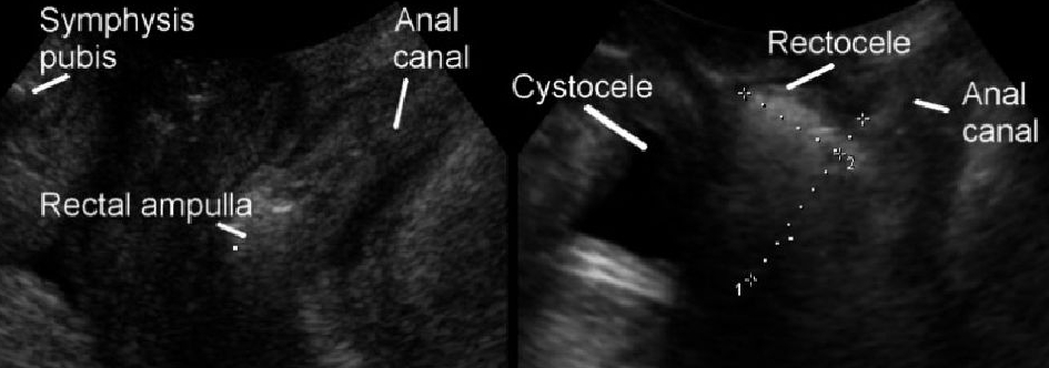 孕中期漏尿是盆底肌受损吗,产前漏尿需要做盆底肌修复吗