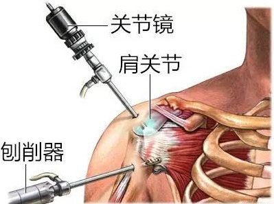 肩膀痛不一定就是肩周炎,肩周炎肩膀痛有什么好方法治疗