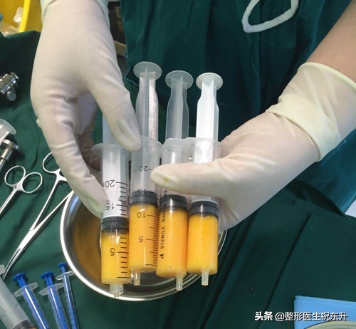 脂肪填充面部减龄部位,面部凹陷脂肪填充演示