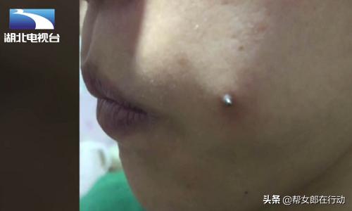 女子打玻尿酸毁容,女子打钢钉致脸发炎视频