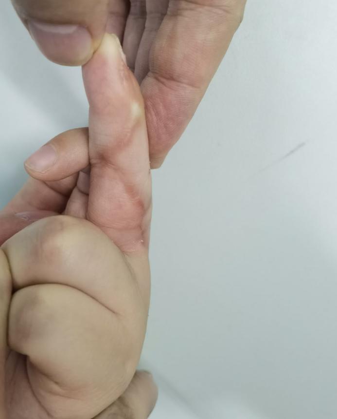 并指畸形免植皮案例,并指畸形