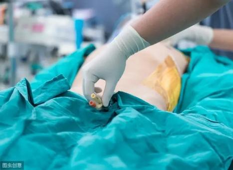 做哪些手术需要插尿管,哪些手术术前须留置导尿管