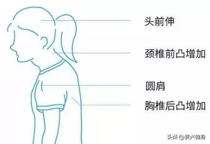 调理上交叉综合征动作,交叉综合症矫正方法