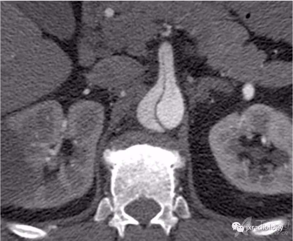 急性主动脉综合征报道,急性主动脉综合征症状