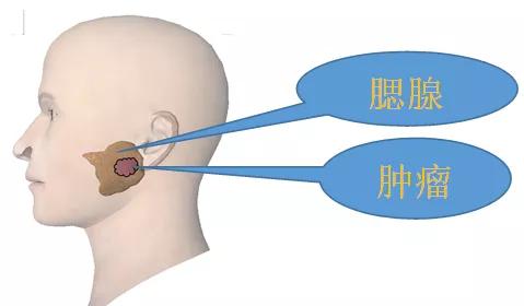 腮帮子肿起来了怎么回事,牙龈肿腮帮子肿起怎么快速消肿