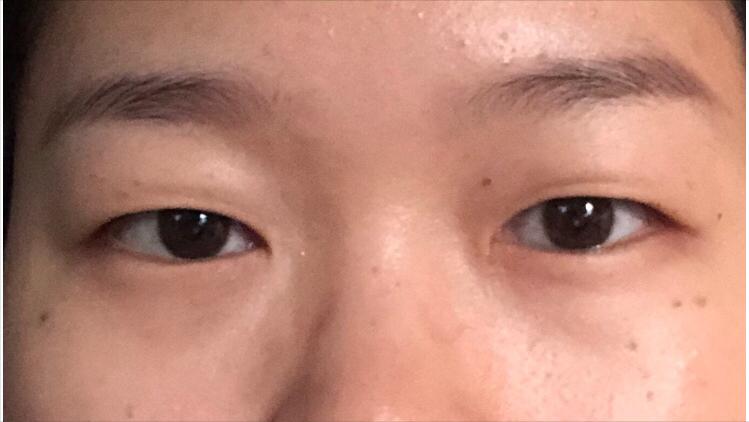 做个双眼皮手术30000块钱贵吗,做双眼皮花了15000贵了吗