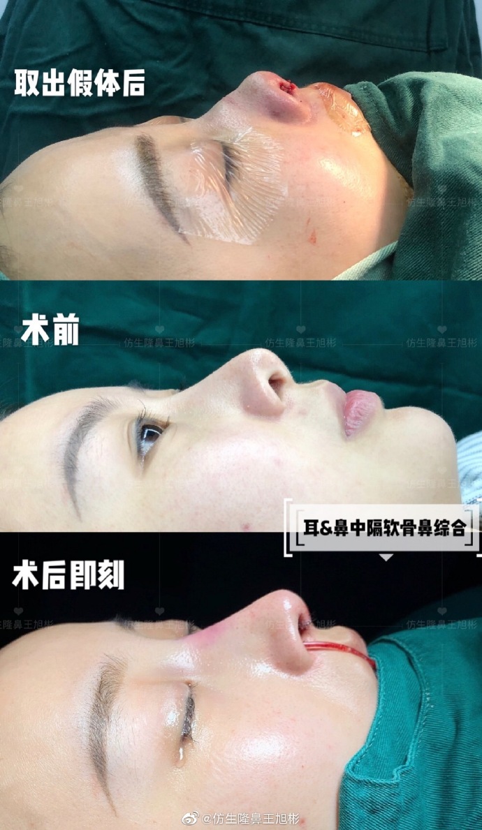 假体隆鼻耳软骨垫鼻尖图片,l型假体耳软骨隆鼻图片