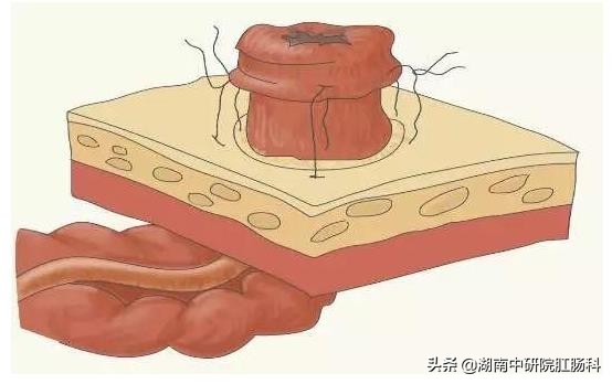 造口患者日常生活护理宣教,造口病人夏季护理