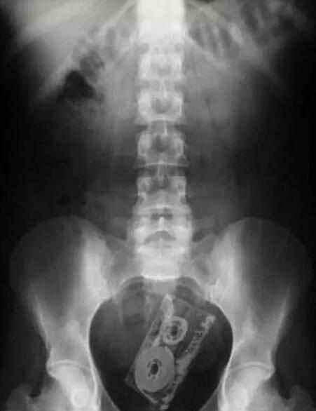 不作死就不会死，看看这些被人类搞进身体里的异物