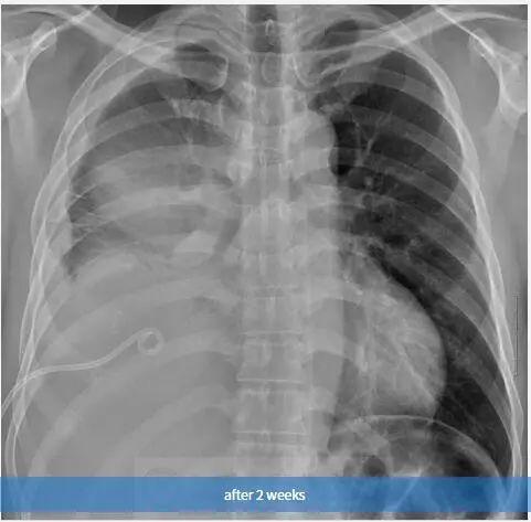 胸壁疼痛的典型特征,临床诊断胸痛是什么意思
