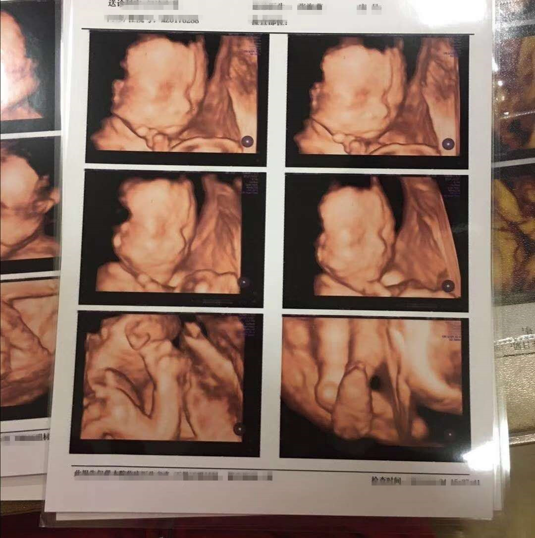 双胞胎！四维顺利通过啦！七年的等待终于盼来好结果！