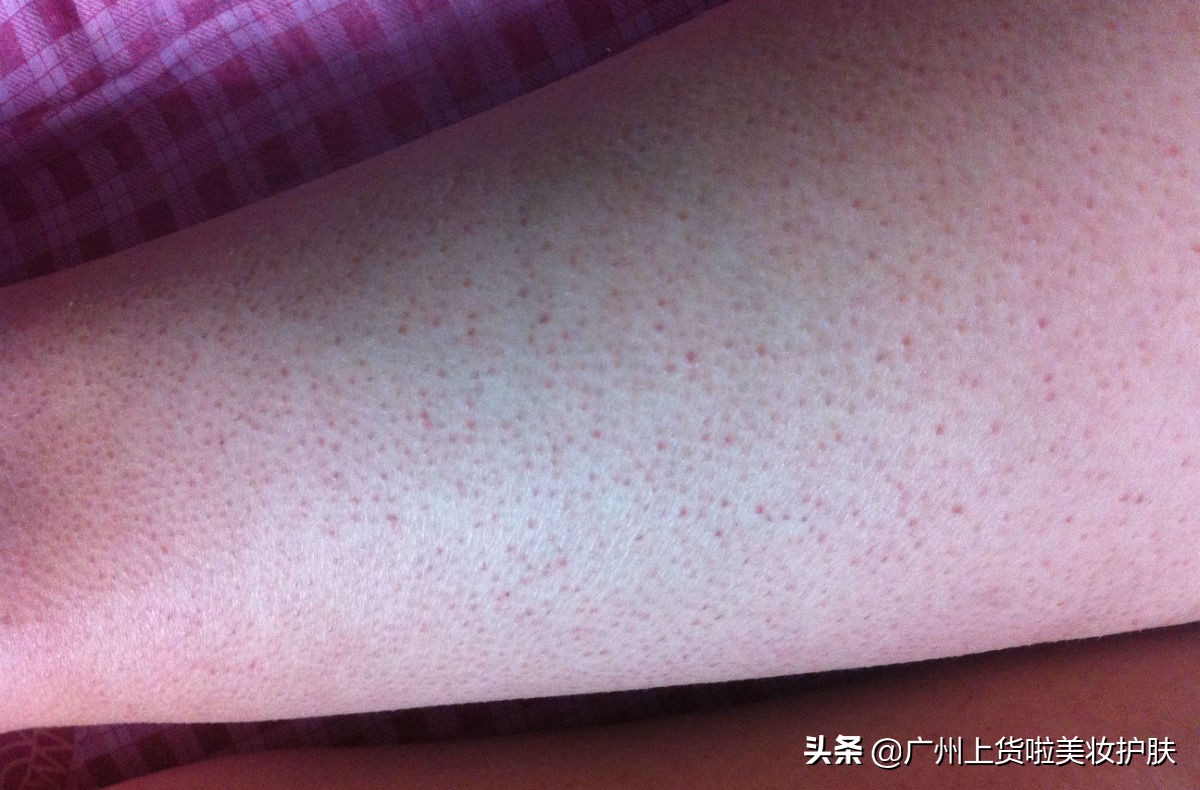 火辣夏季，想做个热辣女神，然而鸡皮肤却毁了你的热夏梦？