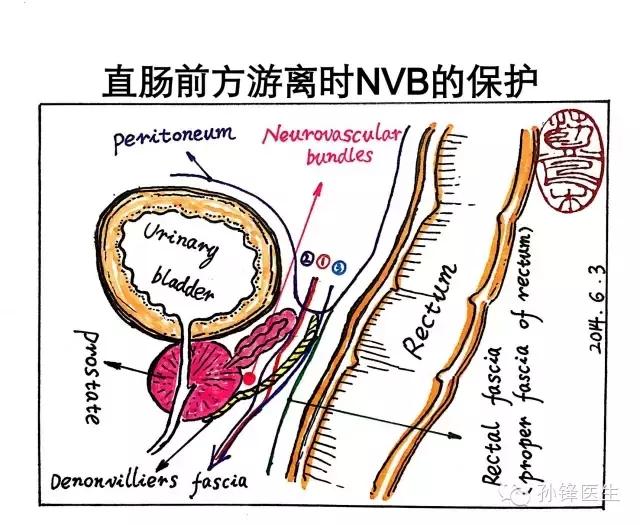 医学干货︱邓氏筋膜：横在直肠癌手术前面的“一道坎儿”