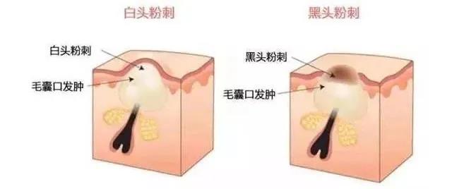 闭口应该怎么处理,闭口怎么办最有效的方法