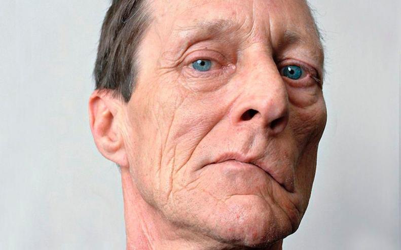 睡一觉起来嘴巴中风了,嘴歪是面瘫还是中风的原因