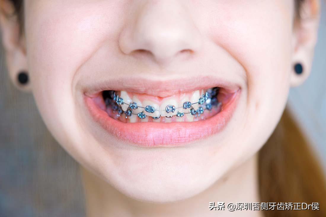 牙齿矫正拔牙注意事项,牙齿矫正需要注意什么问题