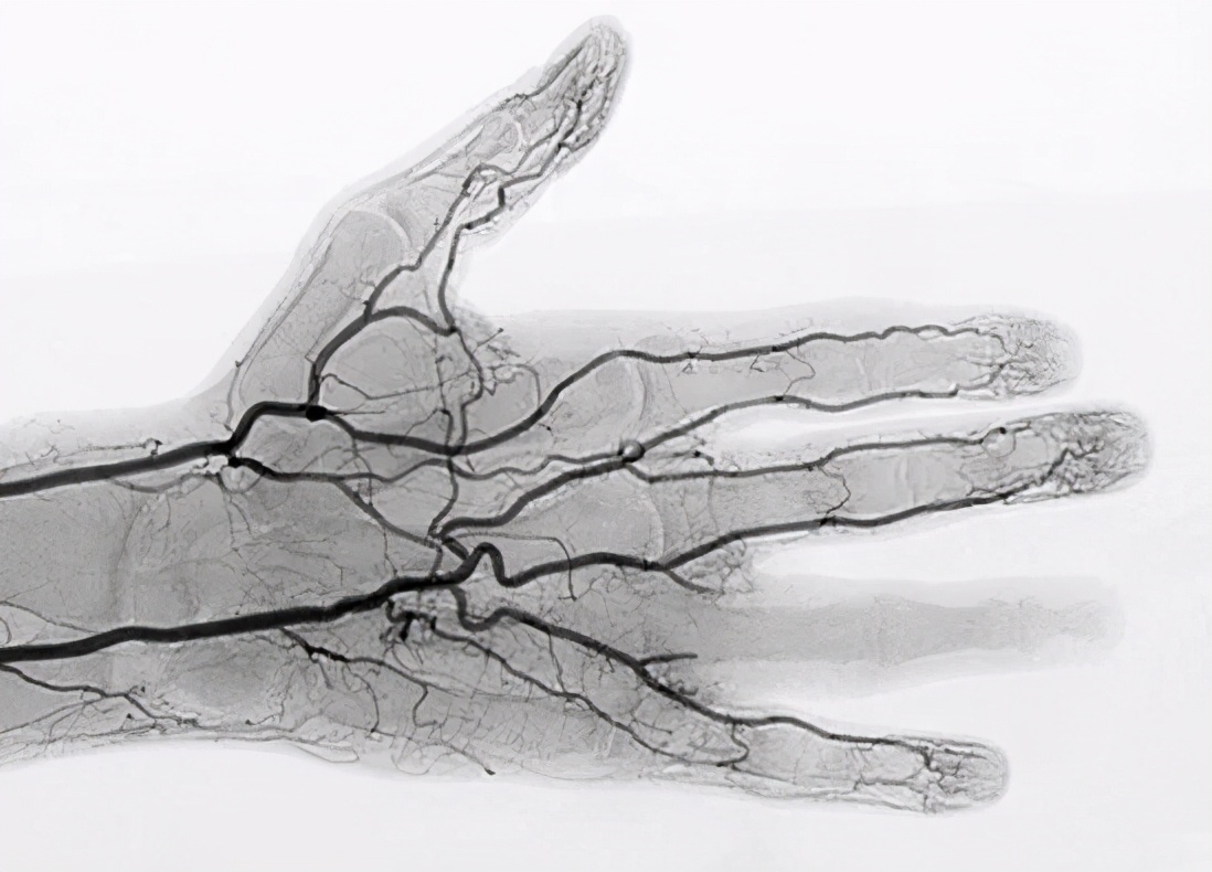 手指肚破了一直流血,手指肚裂小口怎么治