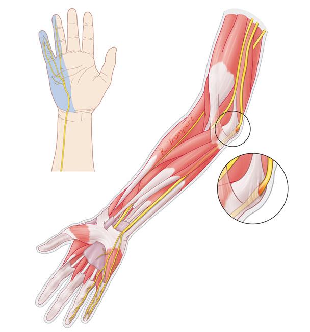 胳膊肘弯曲伸不直有10多年怎么办,胳膊肘转动但是不动