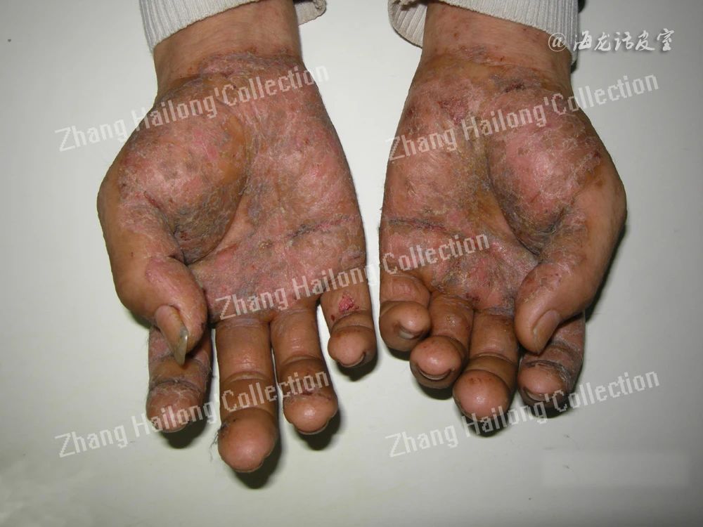 手部湿疹怎样治疗才能断根,手部湿疹怎么治用些什么药呢