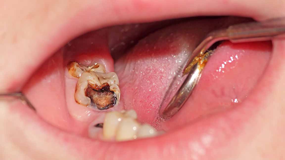 拔牙干槽症几天能治愈,干槽症不处理牙窝会愈合吗