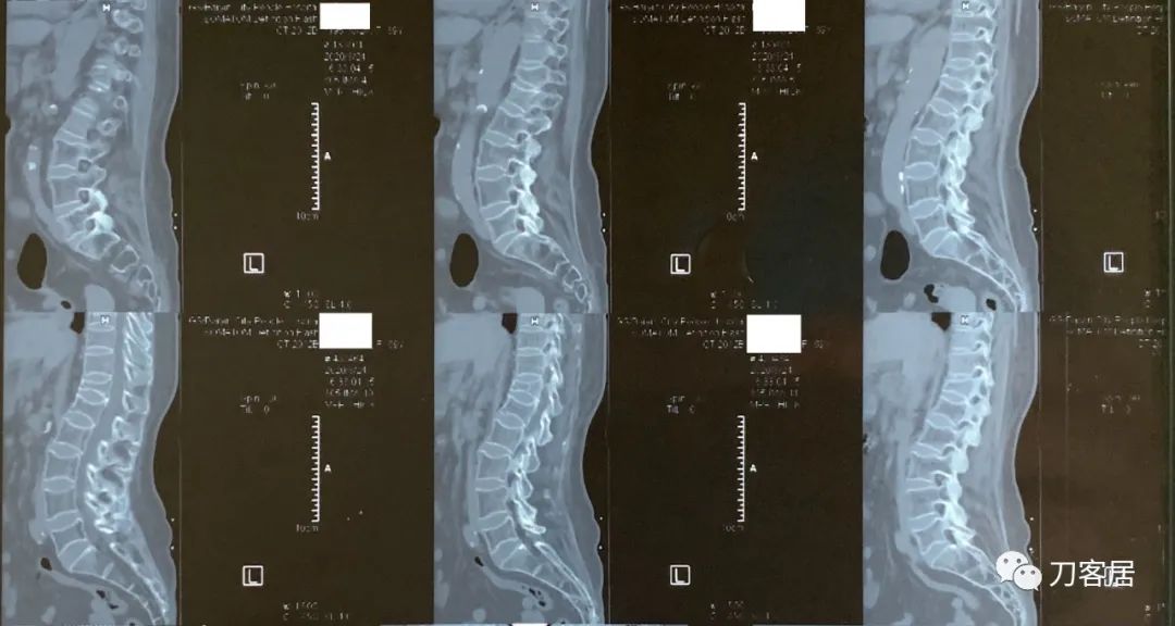 脊柱骨质疏松性压缩性骨折,老年骨质疏松压缩性骨折诊治